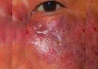 ब्लैक फंगस बना चुनौती:जिले में 60 रोगी, इनमें से 25 के ऑपरेशन हुए लेकिन इंजेक्शन नहीं हैं