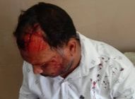 जाहिलपन की हद कर दी:उज्जैन में टीकाकरण करने गई तहसीलदार की टीम पर हमला